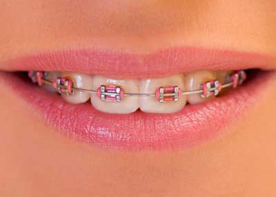 Metall Bracket